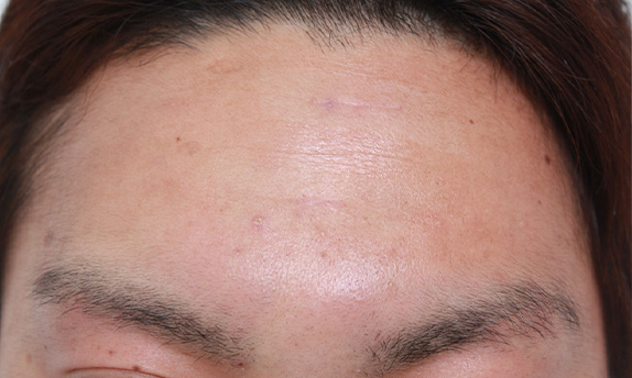 傷跡,ニキビ跡、水ぼうそう跡の修正手術の症例写真,After(1ヶ月後),ba_keisei16_b.jpg