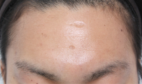 傷跡,ニキビ跡、水ぼうそう跡の修正手術の症例写真,手術前,mainpic_keisei04a.jpg