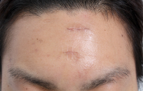 傷跡,ニキビ跡、水ぼうそう跡の修正手術の症例写真,1週間後,mainpic_keisei04c.jpg