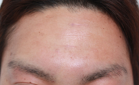 傷跡,ニキビ跡、水ぼうそう跡の修正手術の症例写真,1ヶ月後,mainpic_keisei04d.jpg