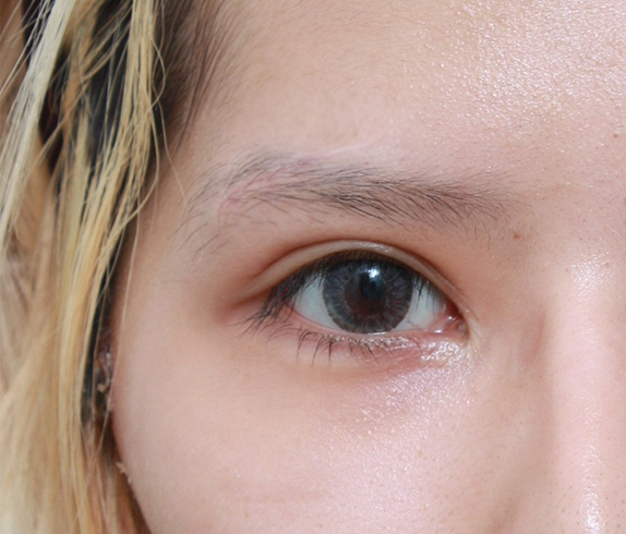 傷跡,傷跡修正手術の症例写真,After(1ヶ月後),ba_keisei18_b.jpg