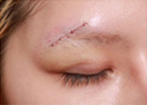 傷跡,傷跡修正手術の症例写真,手術直後,mainpic_keisei06f.jpg