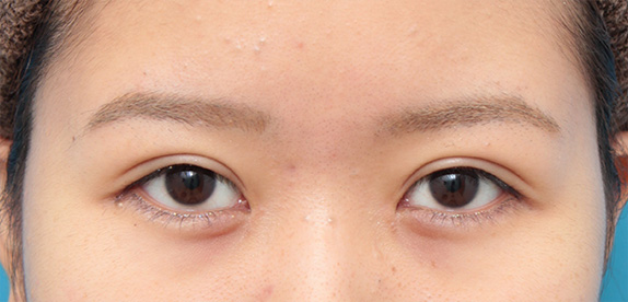 垂れ目（パンダ目）形成（グラマラスライン／下眼瞼下制術）,目頭切開+タレ目形成(下眼瞼下制術、グラマラスライン)の症例写真,After（6ヶ月後）,ba_megashira26_b.jpg