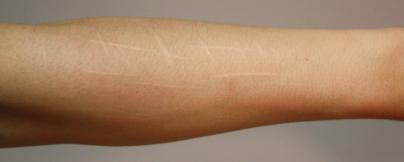 傷跡,リストカット・根性焼き,リストカットの傷跡を手術にて修正した症例写真,Before,ba_keisei13_b.jpg