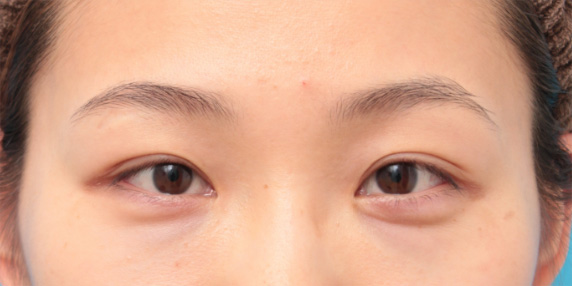 目頭切開,目頭切開の症例 蒙古ひだを皮弁に含めるZ法で手術した20代女性,After（6ヶ月後）,ba_megashira30_a01.jpg