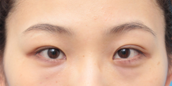 症例写真,目頭切開の症例 蒙古ひだを皮弁に含めるZ法で手術した20代女性,Before,ba_megashira30_b.jpg