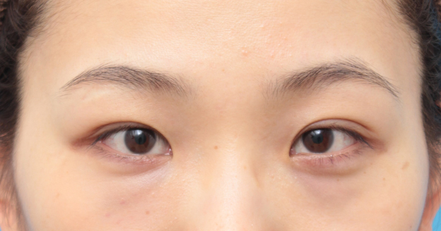 症例写真,目頭切開の症例 蒙古ひだを皮弁に含めるZ法で手術した20代女性,手術前,mainpic_megashira29a.jpg