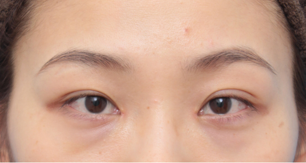 症例写真,目頭切開の症例 蒙古ひだを皮弁に含めるZ法で手術した20代女性,1週間後,mainpic_megashira29c.jpg