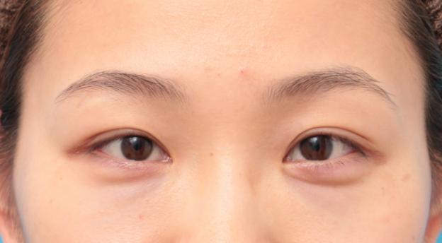 症例写真,目頭切開の症例 蒙古ひだを皮弁に含めるZ法で手術した20代女性,6ヶ月後,mainpic_megashira29d.jpg