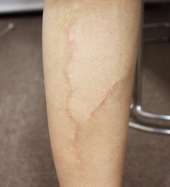 傷跡,傷跡の症例写真　脚の傷跡を手術で修正,After,ba_keisei11_a01.jpg