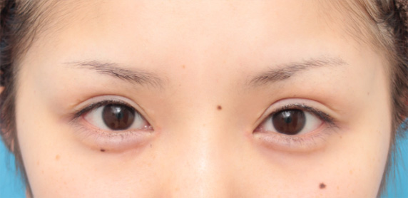 目頭切開,目頭切開で目を内側に大きくし平行型二重を際立たせた症例写真,After（6ヶ月後）,ba_megashira32_a01.jpg