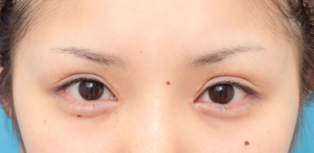目頭切開,目頭切開で目を内側に大きくし平行型二重を際立たせた症例写真,6ヶ月後,mainpic_megashira31e.jpg