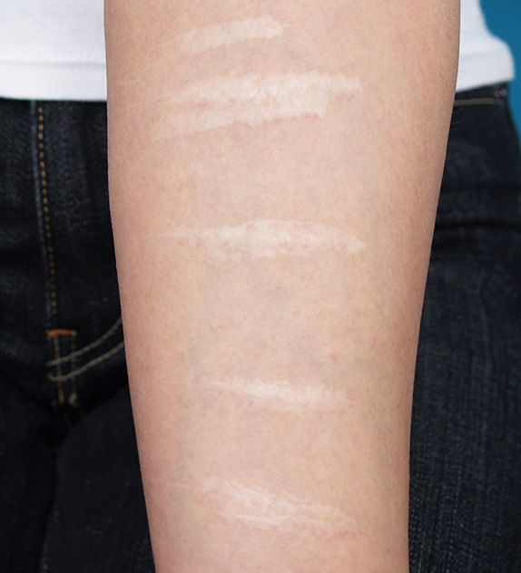 傷跡,傷跡の症例写真　リストカット傷をレーザーで治療,Before,ba_keisei10_b.jpg