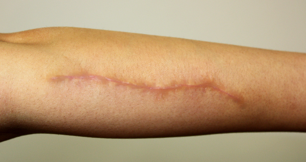 リストカット・根性焼き,傷跡修正の症例写真 腕にたくさんあったタバコの火傷跡を手術で修正,After,ba_keisei14_b.jpg