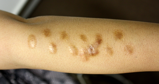 傷跡,傷跡修正の症例写真 腕にたくさんあったタバコの火傷跡を手術で修正,Before,ba_keisei14_b.jpg
