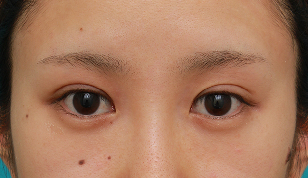 目尻切開,目頭切開+目尻切開で目の横幅を内側と外側に広げた20代女性の症例写真,手術前,mainpic_megashira32a.jpg