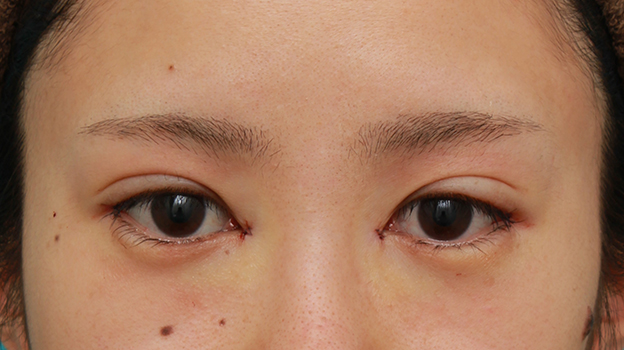 症例写真,目頭切開+目尻切開で目の横幅を内側と外側に広げた20代女性の症例写真,手術直後,mainpic_megashira32b.jpg