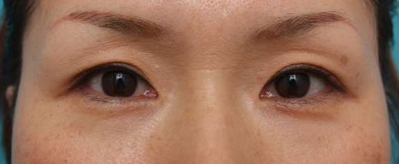 目尻切開,目尻切開 30代女性、術後1ヶ月の症例写真,After（1ヶ月後）,ba_mejiri01_b.jpg