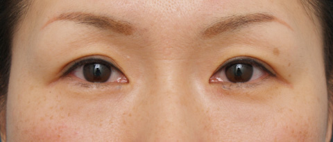 目尻切開,目尻切開 30代女性、術後1ヶ月の症例写真,施術前,mainpic_mejiri01a.jpg