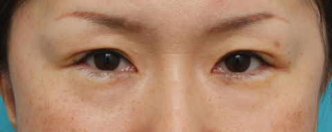 症例写真,目尻切開 30代女性、術後1ヶ月の症例写真,施術直後,mainpic_mejiri01b.jpg