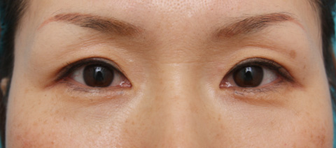 目尻切開,目尻切開 30代女性、術後1ヶ月の症例写真,1ヶ月後,mainpic_mejiri01c.jpg