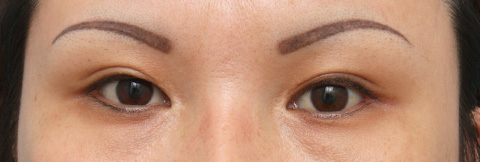 目尻切開,目尻切開の症例 大きな印象の目をご希望の20代女性,施術前,mainpic_mejiri02a.jpg
