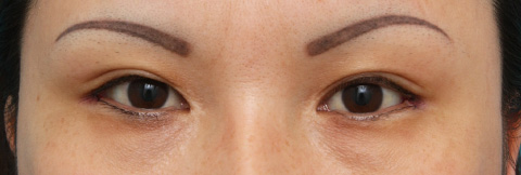 症例写真,目尻切開の症例 大きな印象の目をご希望の20代女性,施術直後,mainpic_mejiri02b.jpg