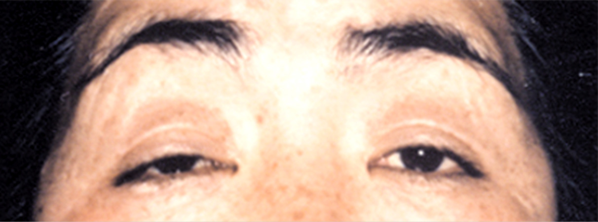 眼瞼下垂（がんけんかすい）,眼瞼下垂（がんけんかすい） まぶたが目にかぶさり片目はほとんど開いていない症例,Before,ba_ganken17_b.jpg