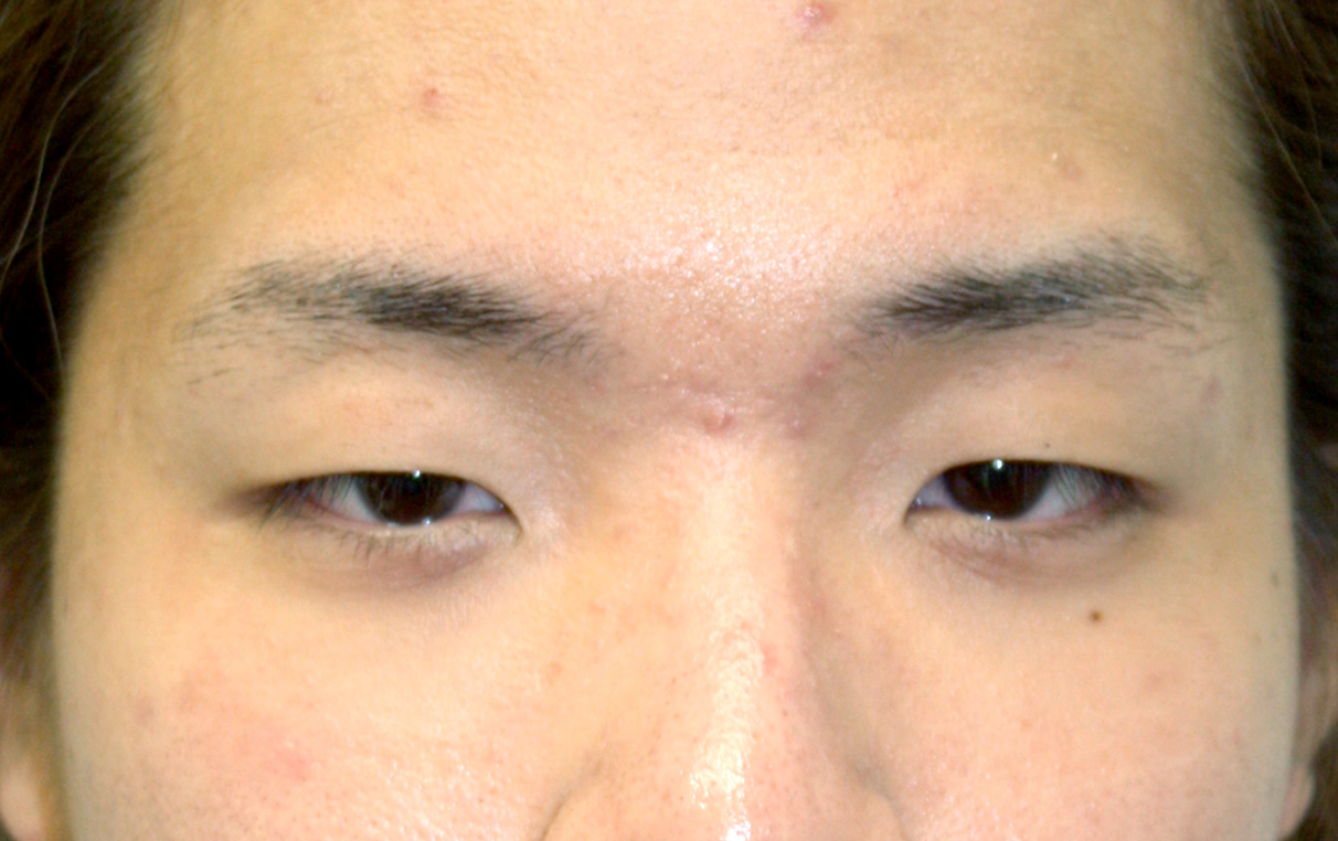 眼瞼下垂（がんけんかすい）,眼瞼下垂（がんけんかすい） まぶたが下がり老けてみえがちな男性の症例,Before,ba_ganken21_b.jpg
