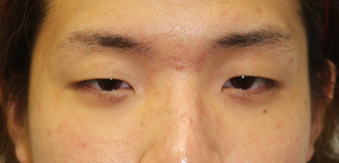 症例写真,眼瞼下垂（がんけんかすい） まぶたが下がり老けてみえがちな男性の症例,施術前,mainpic_gankena.jpg