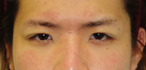 眼瞼下垂（がんけんかすい）,眼瞼下垂（がんけんかすい） まぶたが下がり老けてみえがちな男性の症例,施術直後,mainpic_gankenb.jpg