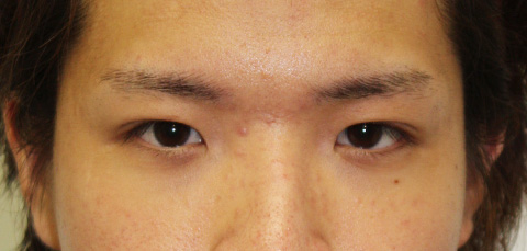 眼瞼下垂（がんけんかすい）,眼瞼下垂（がんけんかすい） まぶたが下がり老けてみえがちな男性の症例,1ヶ月後,mainpic_gankenc.jpg