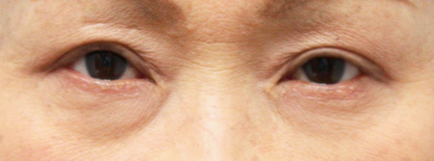 眼瞼下垂（がんけんかすい）,眼瞼下垂（がんけんかすい） 60代女性の老人性眼瞼下垂患者様の症例,After,ba_ganken27_b.jpg