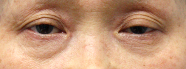 症例写真,眼瞼下垂（がんけんかすい） 60代女性の老人性眼瞼下垂患者様の症例,Before,ba_ganken27_b.jpg