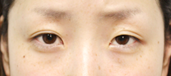 眼瞼下垂（がんけんかすい）,眼瞼下垂（がんけんかすい）の症例写真 目頭切開も施行,Before,ba_ganken29_b.jpg