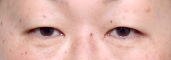 症例写真,眼瞼下垂（がんけんかすい） 一重で目が小さく見えた30代女性の症例写真,Before,ba_ganken19_b.jpg