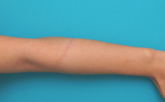 傷跡,リストカット・根性焼き,リストC.の傷跡を切除縫縮した症例写真,After(3ヶ月後),ba_keisei20_a01.jpg