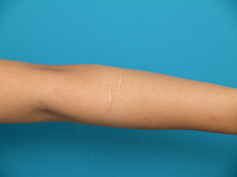 リストカット・根性焼き,リストC.の傷跡を切除縫縮した症例写真,手術前,mainpic_keisei07a.jpg