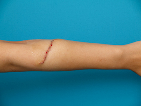 リストカット・根性焼き,リストC.の傷跡を切除縫縮した症例写真,手術直後,mainpic_keisei07b.jpg