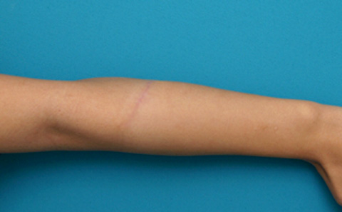リストカット・根性焼き,リストC.の傷跡を切除縫縮した症例写真,3ヶ月後,mainpic_keisei07c.jpg