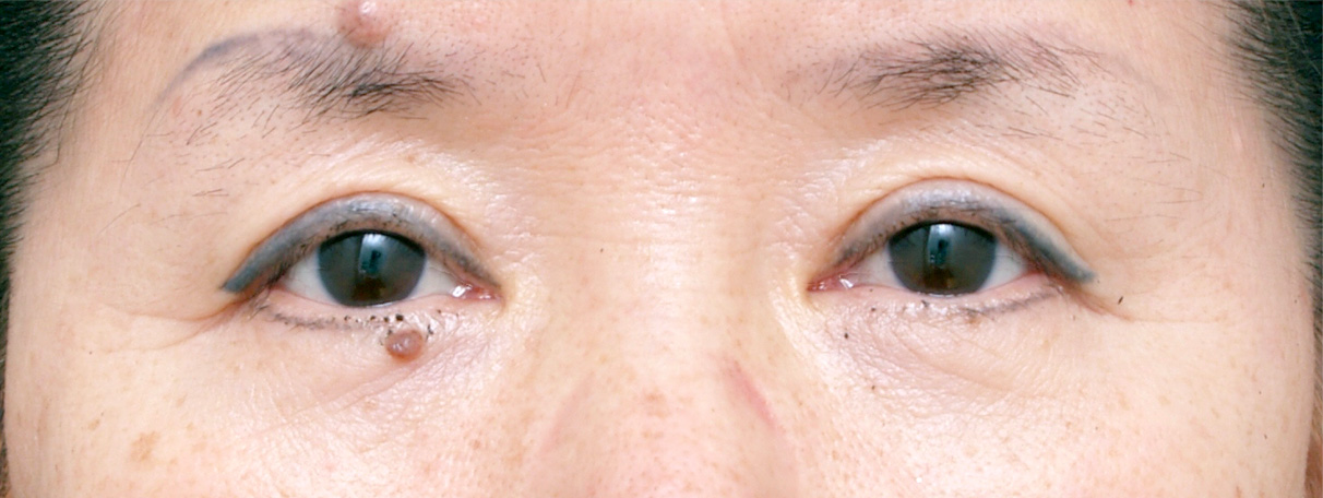眼瞼下垂（がんけんかすい）,眼瞼下垂（がんけんかすい） 左のまぶたが重そうな50代女性の症例,After,ba_ganken22_a01.jpg