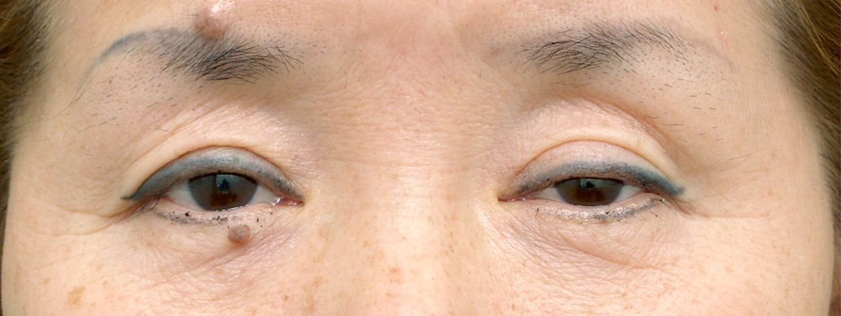 眼瞼下垂（がんけんかすい）,眼瞼下垂（がんけんかすい） 左のまぶたが重そうな50代女性の症例,Before,ba_ganken22_b.jpg
