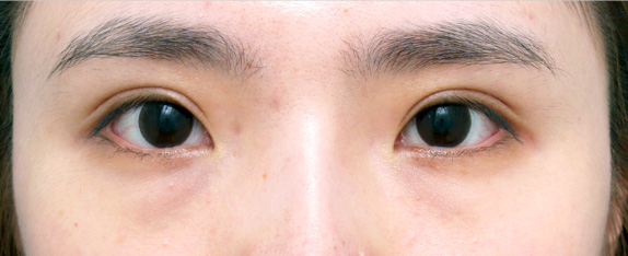 眼瞼下垂（がんけんかすい）,他院で受けた手術の修正（二重まぶた・目もと）,眼瞼下垂（がんけんかすい） 他院施術の修正手術症例,After,ba_ganken23_a01.jpg