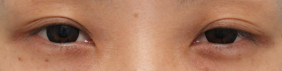 眼瞼下垂（がんけんかすい）,眼瞼下垂手術をして同時に平行型二重を作った症例写真,Before,ba_ganken24_b.jpg