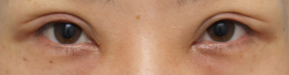 眼瞼下垂（がんけんかすい）,眼瞼下垂手術をして同時に平行型二重を作った症例写真,手術直後,mainpic_ganken05b.jpg