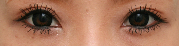 眼瞼下垂（がんけんかすい）,眼瞼下垂手術をして同時に平行型二重を作った症例写真,6ヶ月後,メイクあり,mainpic_ganken05e.jpg
