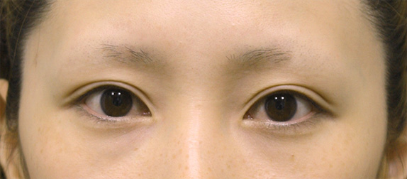眼瞼下垂（がんけんかすい）,眼瞼下垂（がんけんかすい） まぶたが重そうな20代女性の症例,After（メイクなし）,ba_ganken26_a01.jpg