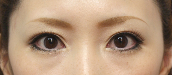 眼瞼下垂（がんけんかすい）,眼瞼下垂（がんけんかすい） まぶたが重そうな20代女性の症例,After（メイクあり）,