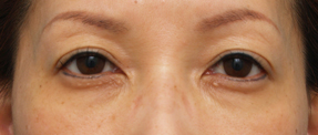 眼瞼下垂（がんけんかすい）,眼瞼下垂（がんけんかすい） まぶたが下がり眠そうな表情の50代女性の症例,After,ba_ganken28_b.png