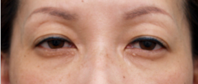 眼瞼下垂（がんけんかすい）,眼瞼下垂（がんけんかすい） まぶたが下がり眠そうな表情の50代女性の症例,Before,ba_ganken28_b.png
